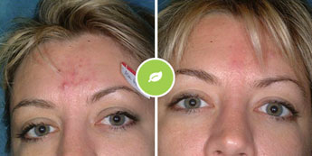 Dermal odstranjevanje aken Elos